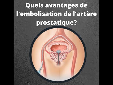 Vidéo: L'embolisation de l'artère prostatique est-elle sûre ?