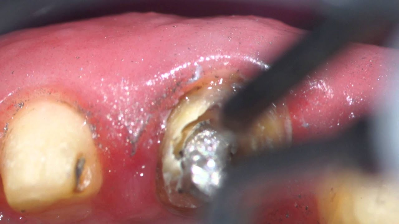 cast post and core