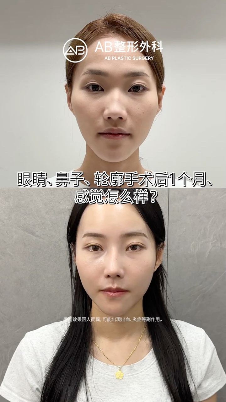 轮廓三件套＋非切开提肌＋鼻整形 Before & After #Shorts