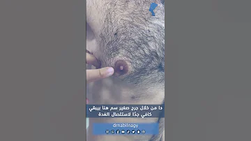 الدرجة الأولى من التثدي جراح التجميل دكتور نبيل ناجي 