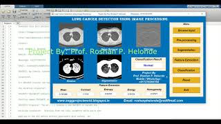 Lung Cancer Detection Using Image Processing | With Source Code | Matlab Project With Source Code