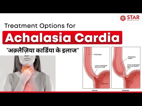 Achalasia Cardia Laparoscopic Surgery Gives Best Results | Endoscopic Balloon Dilatation | Botox