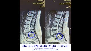 Способів лікування міжхребцевої грижі без операцій