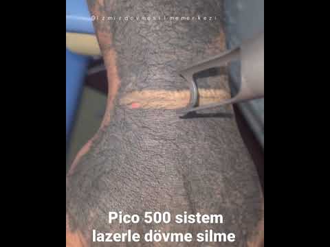 Pico 500 sistem