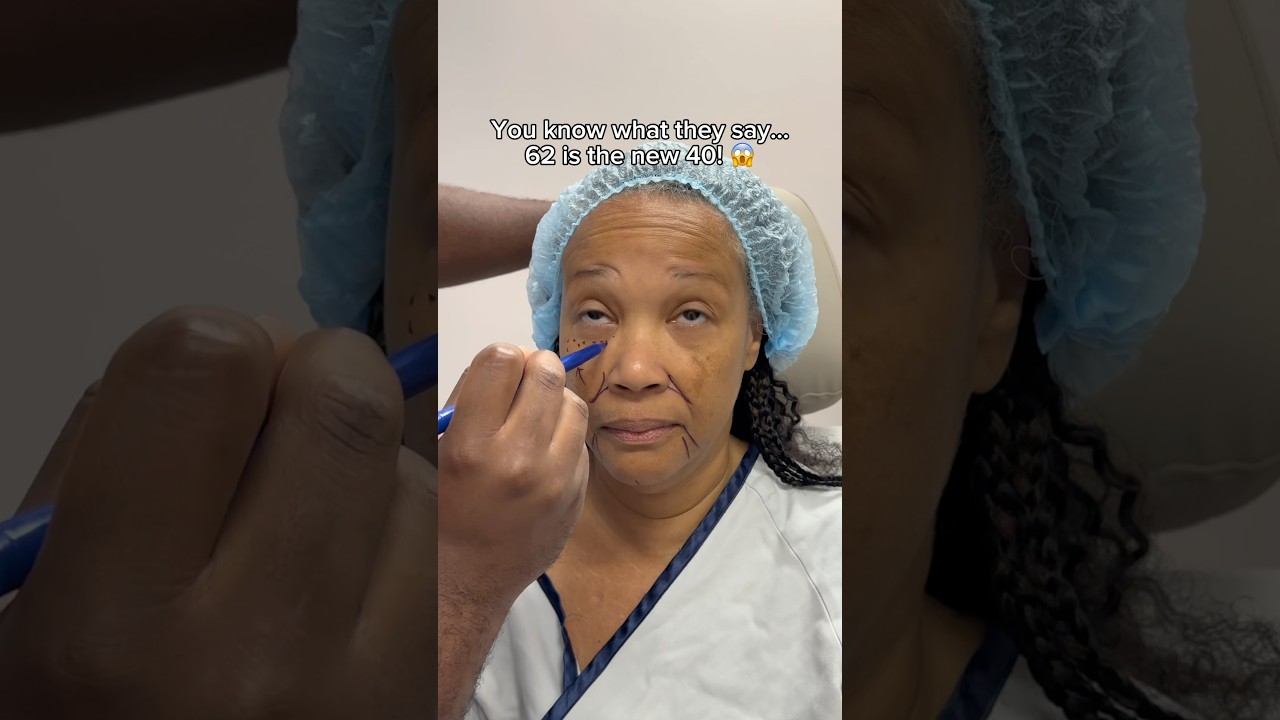 62 is The New 40! VIRAL Facelift Patient is Back 2 Years After Her Transformation 😱