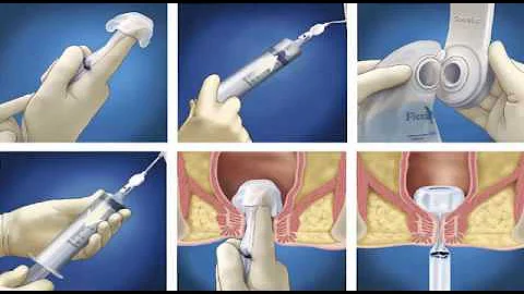 Como colocar a sonda retal?