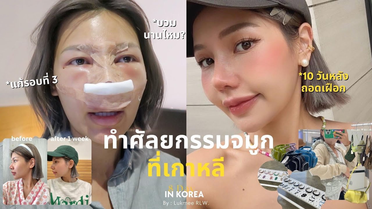 Vlog ศัลยกรรมจมูกที่เกาหลี ! อัพเดตให้วันต่อวัน พร้อมวิธีดูแล + พาช้อปปิ้งแบรนด์สุดฮิต | Lukmeerlw.