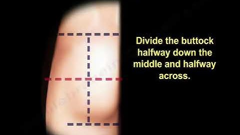 Glute injection, buttock injection