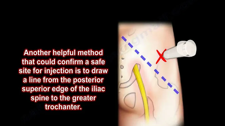 Glute injection, buttock injection