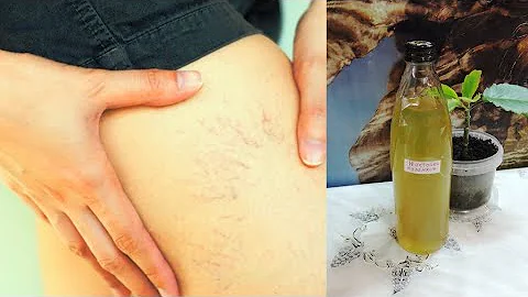 🍀 Каланхоэ, сосудистые 💥 звёздочки, сеточки и 🦵 варикоз. Простое лекарство по цене 🍾 бутылки водки!