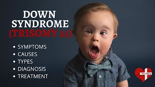 What is Down Syndrome (Trisomy 21)? Down syndrome (Trisomy 21) Made Easy