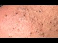Every day remove black head