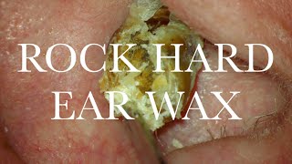 ROCK HARD : EAR WAX REMOVAL : 4K/HD