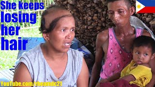 This Poor Filipina Mother Keeps Losing Her Hair and She Doesn't Know Why. Filipinos in Poverty