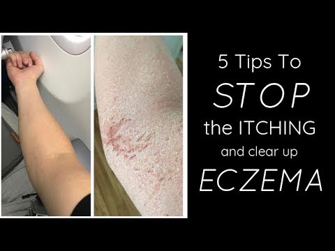 HEALING ECZEMA - 5 Things I Do Each Day To STOP THE ITCH
