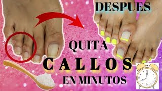 Cómo quitar los callos de los pies? Tratamiento y Remedios - Farmacia GT