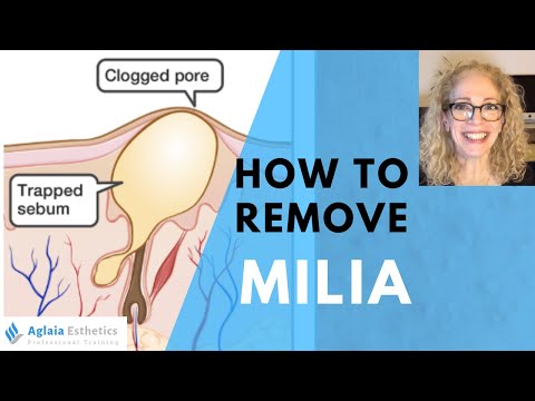 HOW TO REMOVE A MILIA STEP BY STEP | NATURALLY