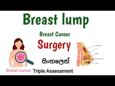 Breast lump , පියයුරු ගැටිති ,Breast cancer , පියයුරු පිලිකා , Surgery , in Sinhala