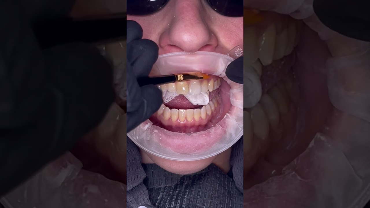 10 LUX NO PREP VENEERS - CHANGING WHATS POSSIBLE!🤩No shaving, no drilling, NO PAIN!  #noprepveneers