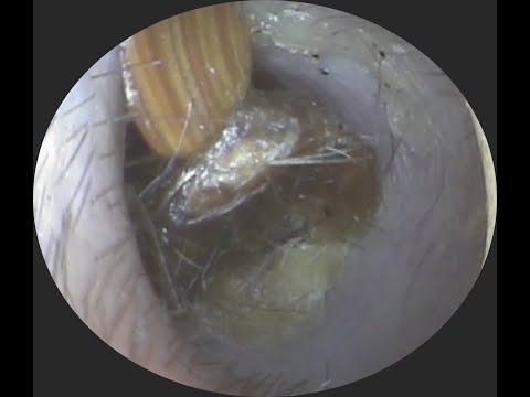 Vol.325【耳掃除】耳の小ささが原因？？毎日きれいにしようとしていた綿棒が・・・eariss