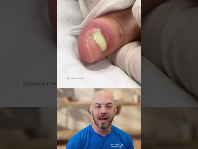 Draining a Fingernail Infection