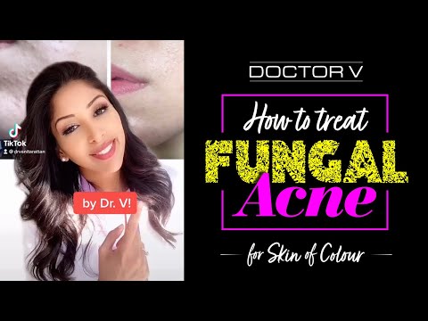 Video: 4 moduri de a evita acneea fungică