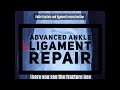 Ankle non union and ligament repair  dr santhosh jacob