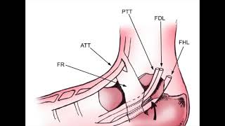 Ultrasound Guided Posterior Tibial Tendon Injection