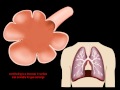 Lungs in motion  emphysema