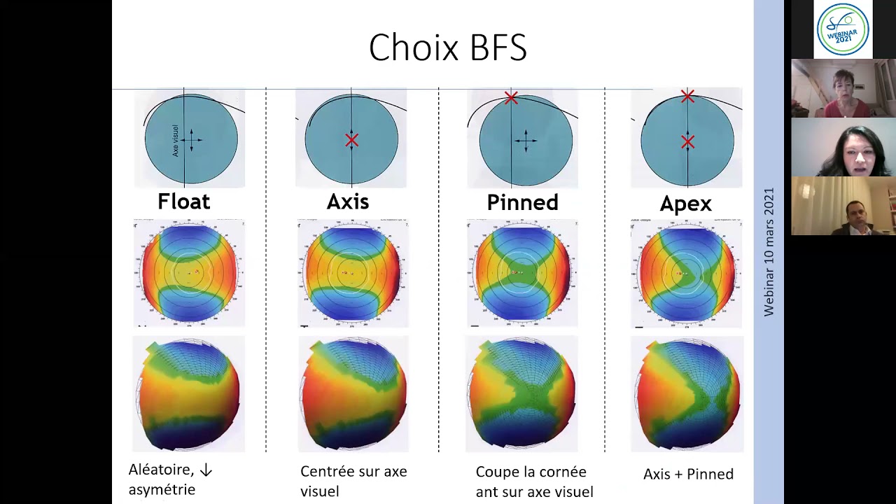 Interview Opthalmologie Webinar SFO Topographie Cornéenne - Mars 2021