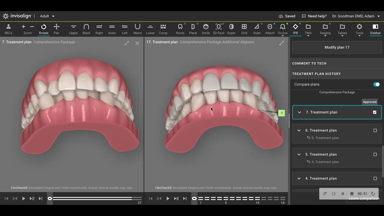 Lower Incisor Extraction Case with only Invisalign Aligners