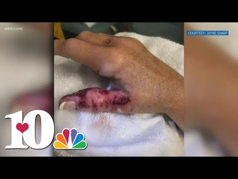 Flesh-eating bacteria almost kills Knoxville woman after nail salon visit