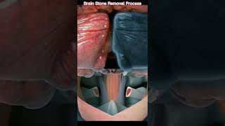 Brain Stone Removal Process