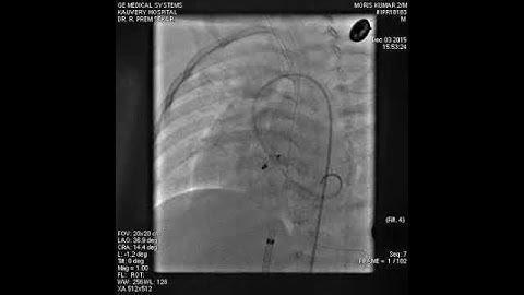 LV Angiogram post device closure of PMVSD