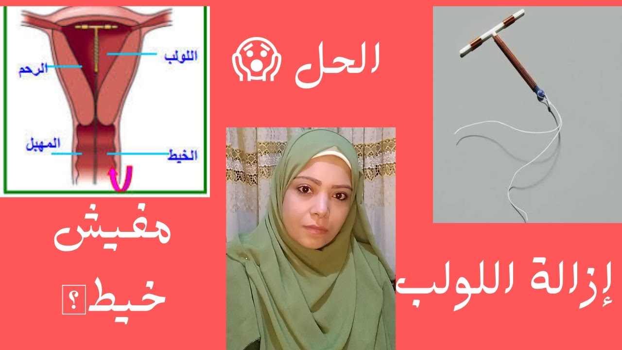 خلع أو ازالة اللولب بدون خيط ؟؟؟؟المختصر المفيد مع د/دعاء حمزه