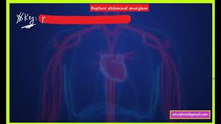 Superficial thrombophlebitis and abdominal aneurysm notes for Australian medical exam (AMC MCQ) screenshot 5