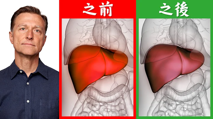 肝炎藥很貴(一顆藥美金1,000元),肝炎4類自然療法,柏格醫生 Dr Berg - 天天要聞