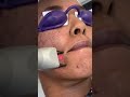 Beforeafter acne and acne scars fractionalcolaser fractionalco2 laser