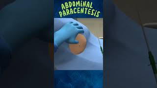 Abdominal Paracentesis 3D Animation Pait Se Pani Nikalna