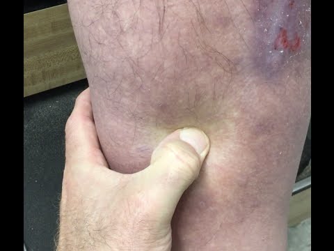 Jefferson Follow Up Video!  2+ Pitting Edema