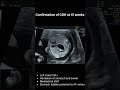 Congenital Diaphragmatic Hernia (CDH) – Early Prenatal Detection on Ultrasound | 12 to 15 Weeks