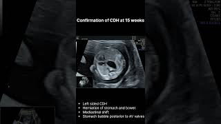 Congenital Diaphragmatic Hernia (CDH) – Early Prenatal Detection on Ultrasound | 12 to 15 Weeks