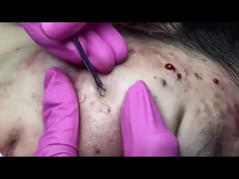 Acne And Blackhead Removal On Eyes, Nose, Cheek and Chin With Relaxing Guitar And Piano Music HD