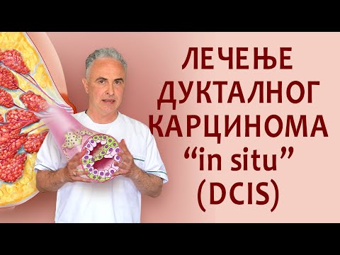 Лечење дукталног карцинома