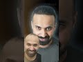 نتيجة زراعة الشعر زراعة الشعر قبل وبعد عيادة زراعة الشعر بزرة ميد 
