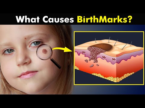 Birthmarks - How