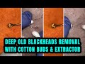 Deep old blackheads removal   with cotton buds  extractor   new 2024