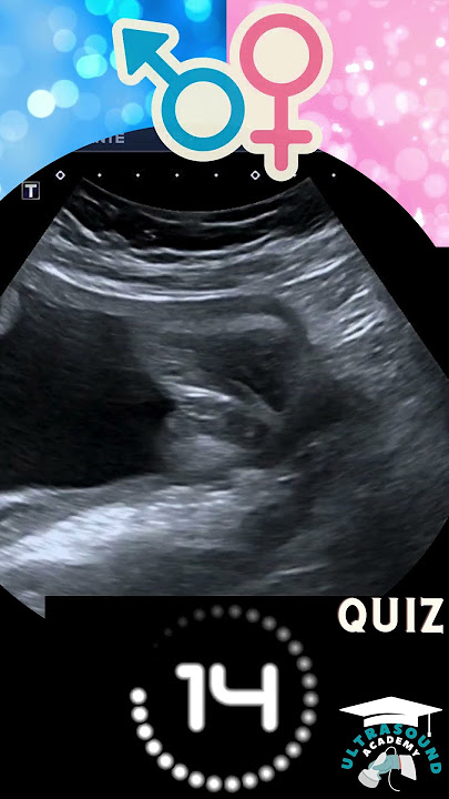 Ultrasound Quiz: Can You Guess?  Boy or Girl? #ultrasound #babygenderprediction #baby