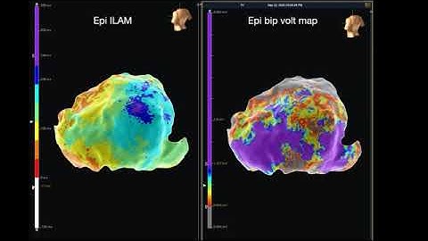 Ventricular tachycardia catheter ablation