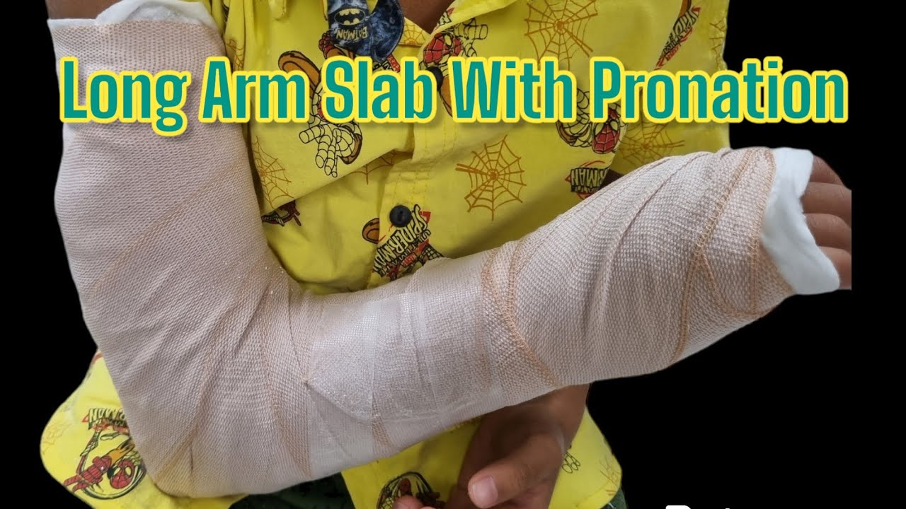 Long Arm Slab Case Fx. Supracondylar Of Humerus YouTube